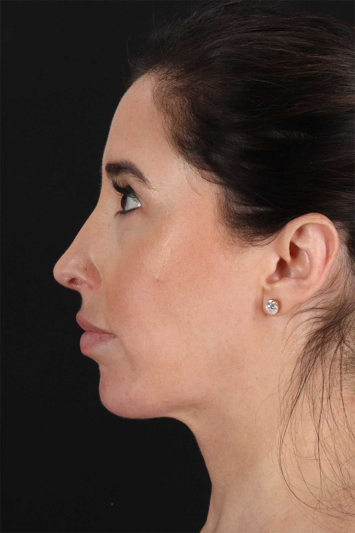 Fat Grafting To The Face Before & After Patient #11783