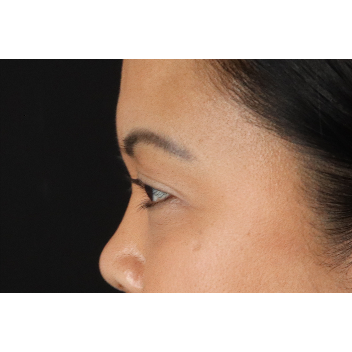 Brow Lift Before & After Patient #11646