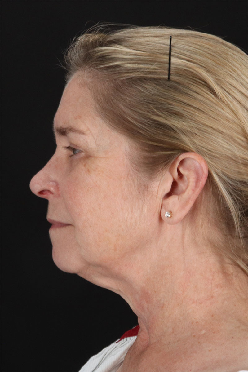 CO2 Laser Before & After Patient #11191