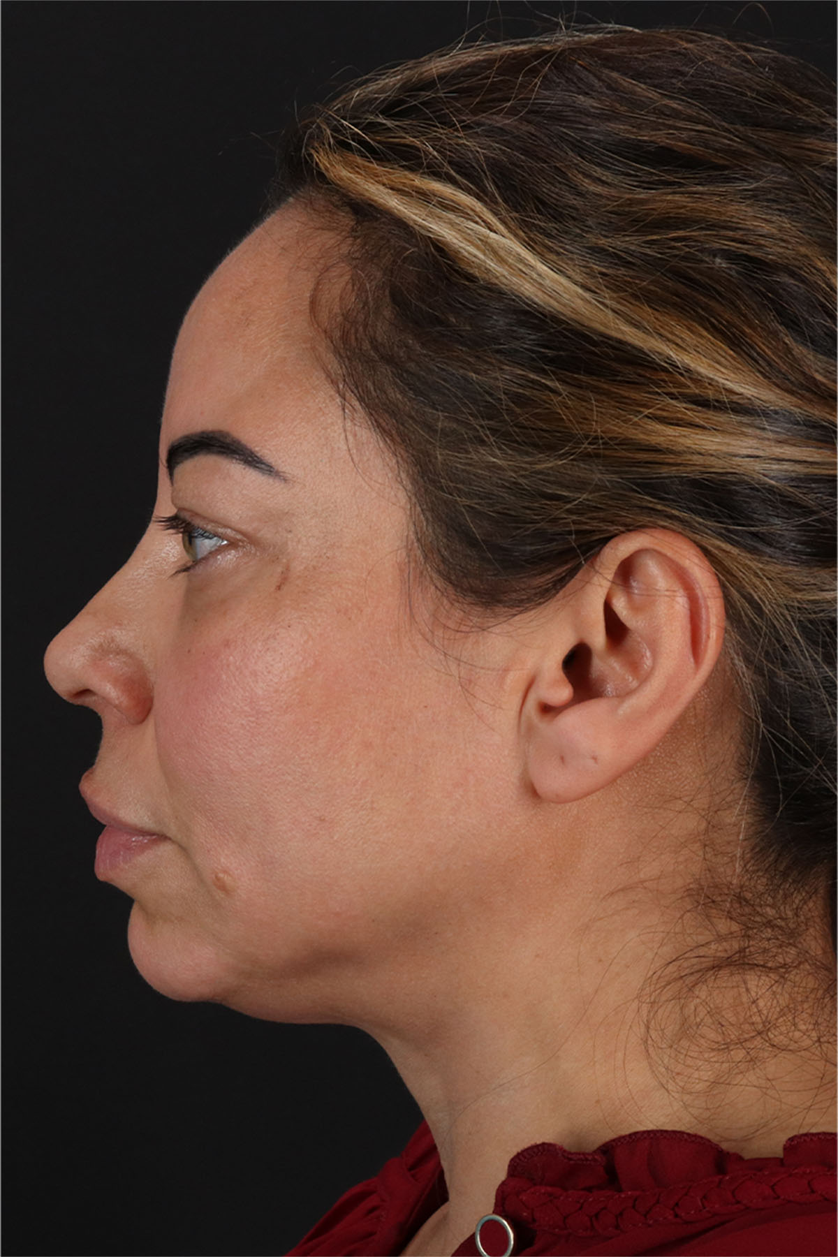CO2 Laser Before & After Patient #11719