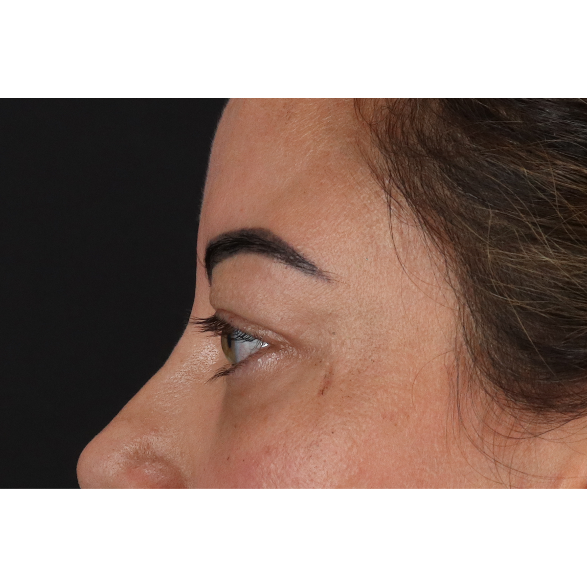 Blepharoplasty (Eyelid Surgery) Before & After Patient #11348