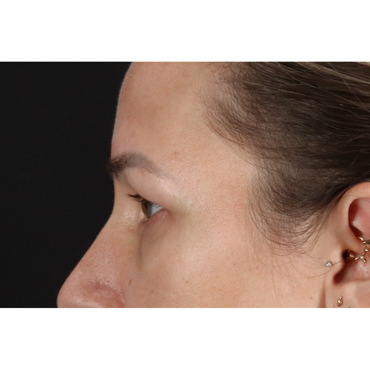 Blepharoplasty (Eyelid Surgery) Before & After Patient #11585