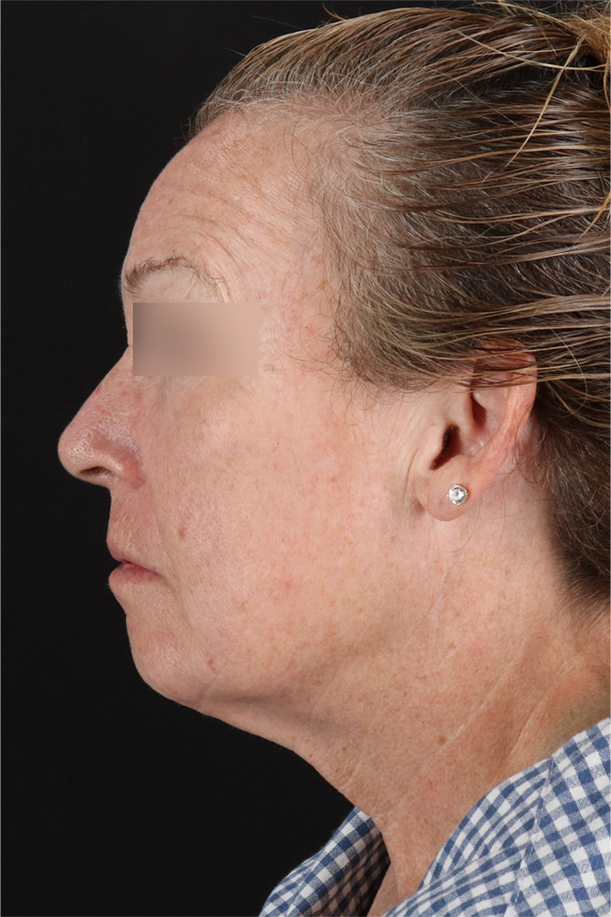 CO2 Laser Before & After Patient #11385