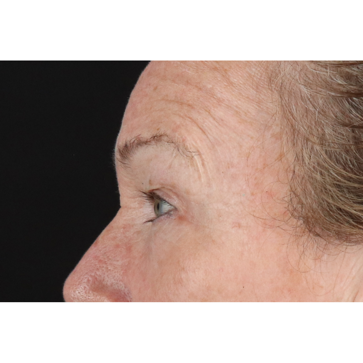 Blepharoplasty (Eyelid Surgery) Before & After Patient #11404