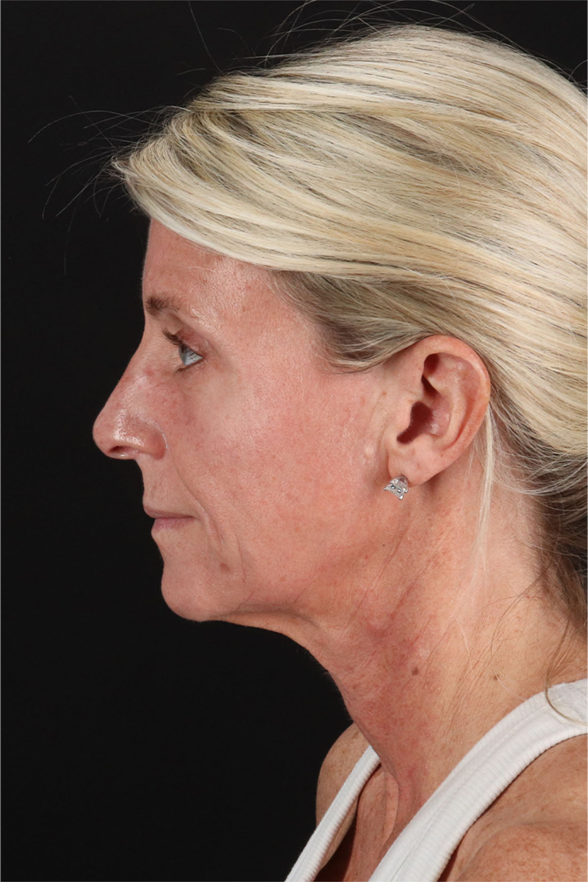 Fat Grafting To The Face Before & After Patient #11753