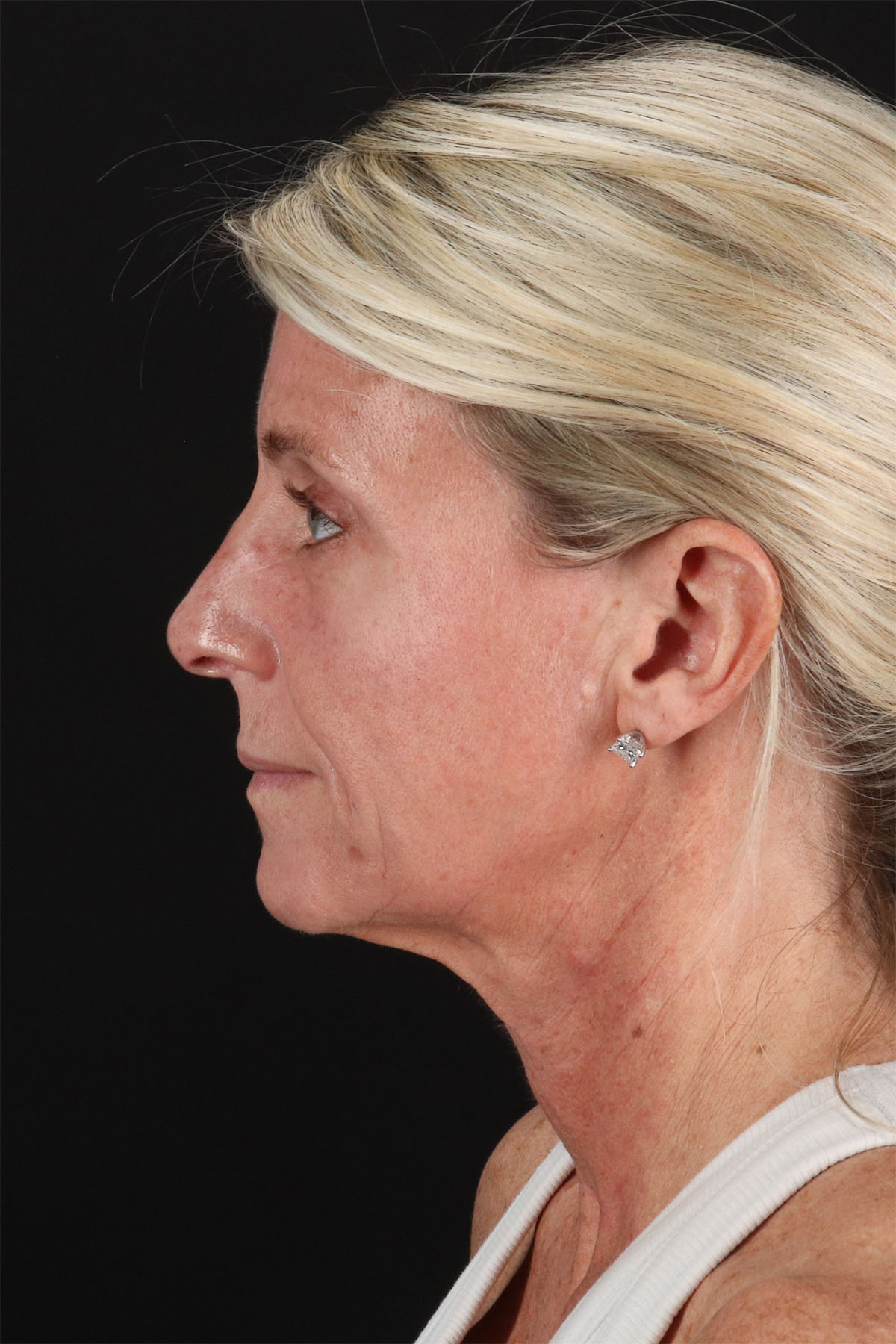 CO2 Laser Before & After Patient #11202