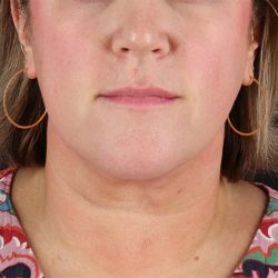 Submental Liposuction Before & After Patient #10505