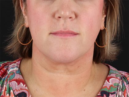 Submental Liposuction Before & After Patient #10505