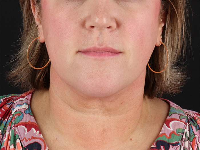 Submental Liposuction Before & After Patient #10505