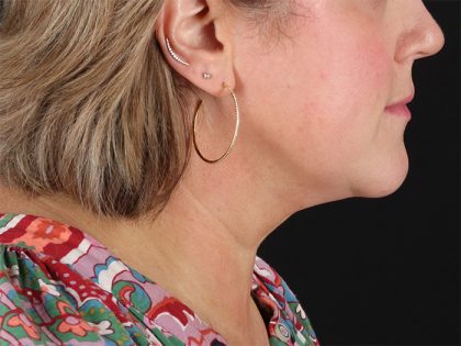 Submental Liposuction Before & After Patient #10505