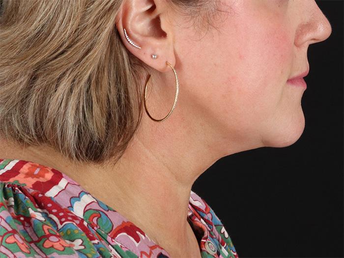 Submental Liposuction Before & After Patient #10505