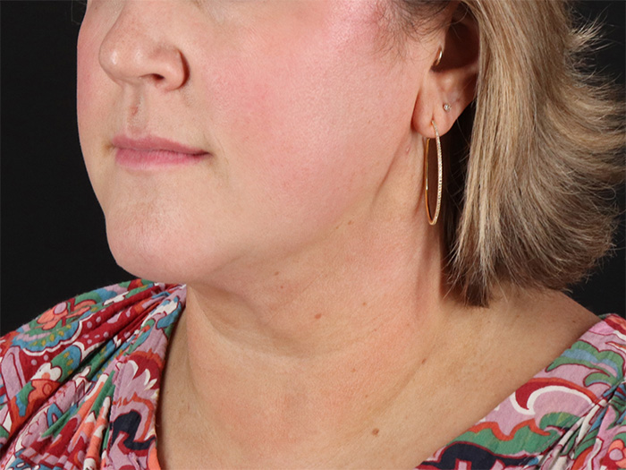 Submental Liposuction Before & After Patient #10505