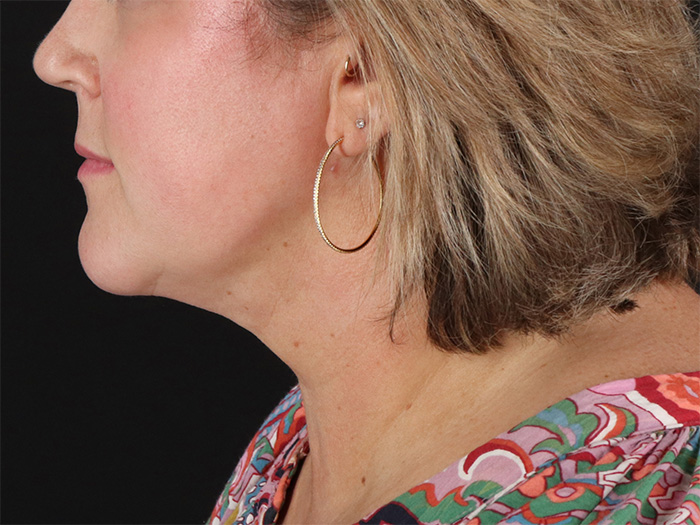 Submental Liposuction Before & After Patient #10505