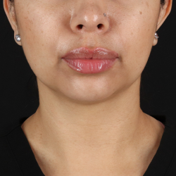 Submental Liposuction Before & After Patient #10494
