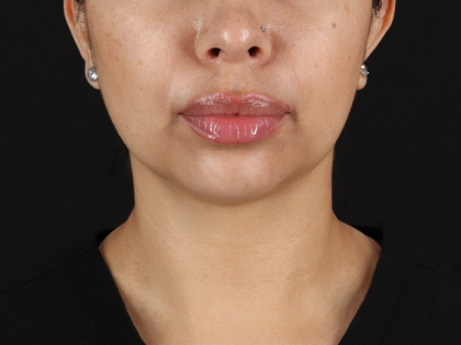 Submental Liposuction Before & After Patient #10494