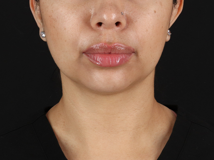 Submental Liposuction Before & After Patient #10494