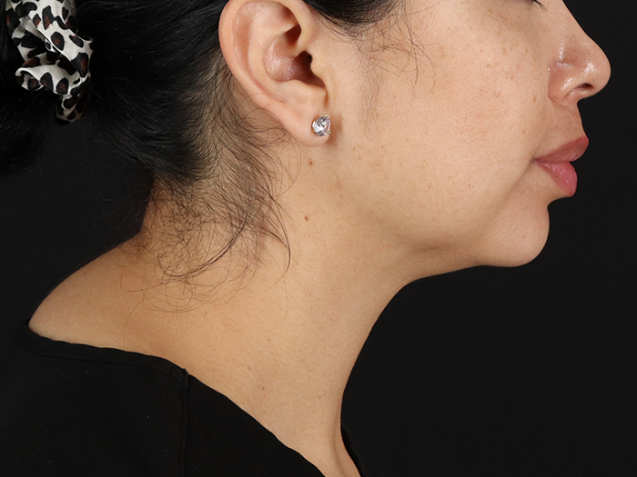 Submental Liposuction Before & After Patient #10494
