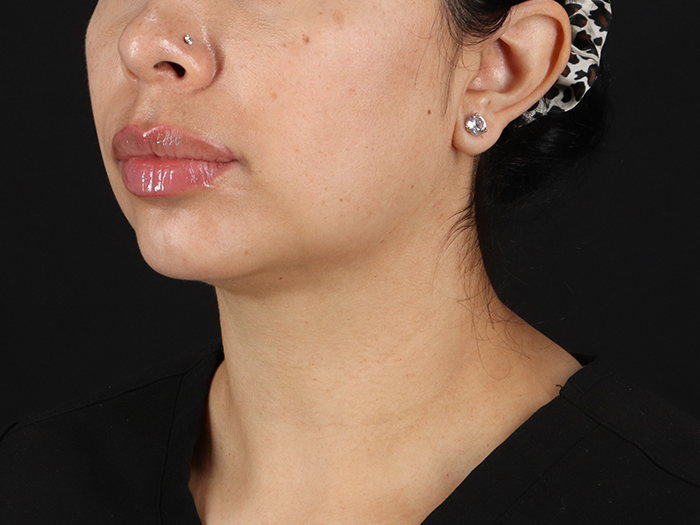 Submental Liposuction Before & After Patient #10494