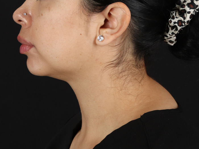 Submental Liposuction Before & After Patient #10494