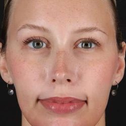 Fillers Before & After Patient #13309