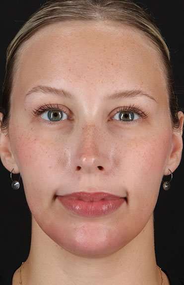 Fillers Before & After Patient #13309