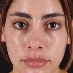 Fillers Before & After Patient #13287