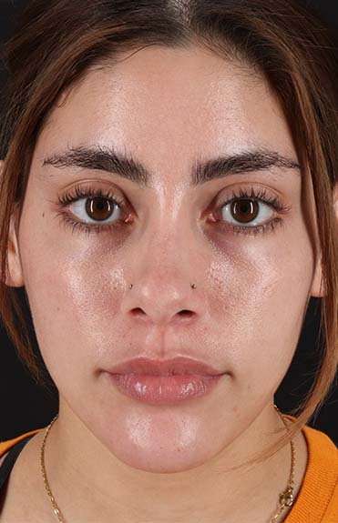 Fillers Before & After Patient #13287