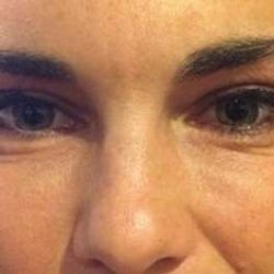 Fillers Before & After Patient #13273