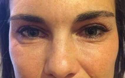 Fillers Before & After Patient #13273