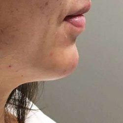 Fillers Before & After Patient #13270