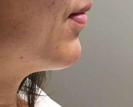 Fillers Before & After Patient #13270