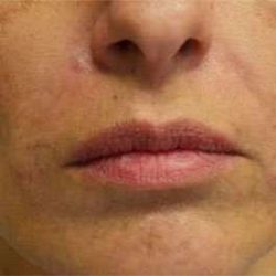 Fillers Before & After Patient #13267