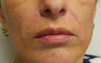 Fillers Before & After Patient #13267