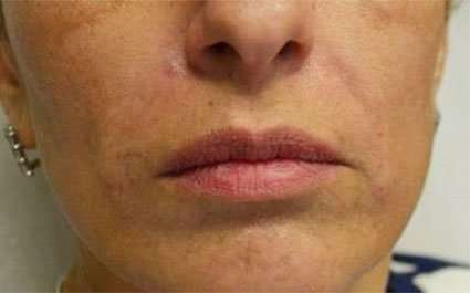 Fillers Before & After Patient #13267
