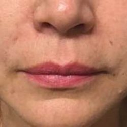 Fillers Before & After Patient #13264