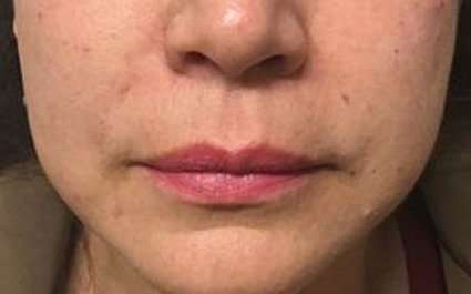 Fillers Before & After Patient #13264