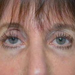 Fillers Before & After Patient #13261