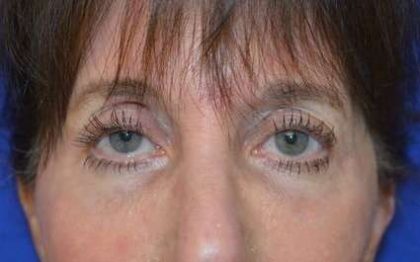 Fillers Before & After Patient #13261