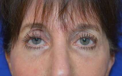 Fillers Before & After Patient #13261