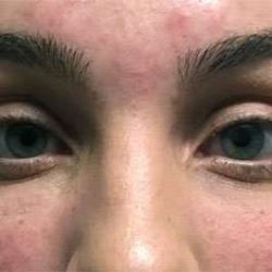 Fillers Before & After Patient #13258