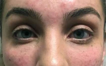 Fillers Before & After Patient #13258