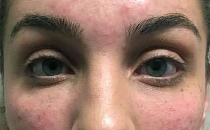Fillers Before & After Patient #13258