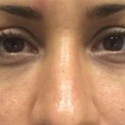 Fillers Before & After Patient #13255