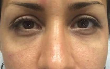 Fillers Before & After Patient #13255