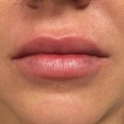 Fillers Before & After Patient #13243