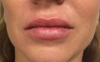 Fillers Before & After Patient #13243