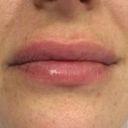 Fillers Before & After Patient #13240