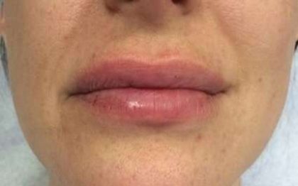 Fillers Before & After Patient #13240