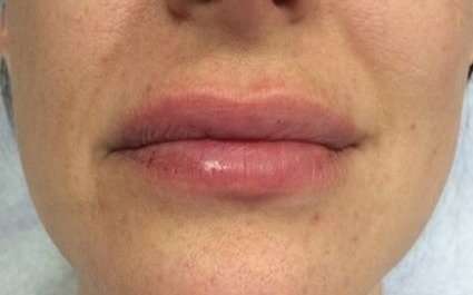 Fillers Before & After Patient #13240