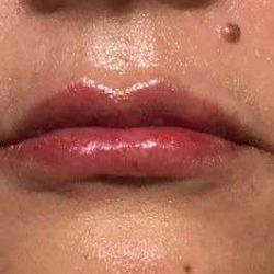 Fillers Before & After Patient #13237